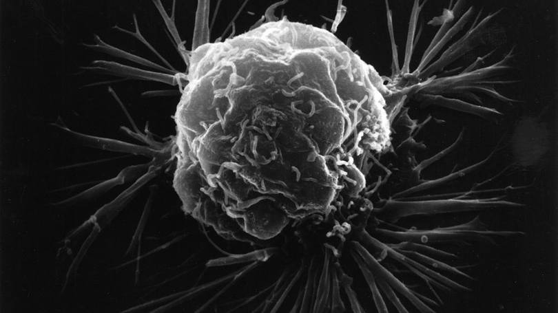 Câncer de mama: doença poderá ser detectada pela saliva