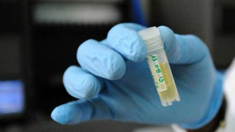 HIV: "Este primeiro transplante praticado na Suíça abre perspectivas inéditas para as pessoas que vivem com o HIV"