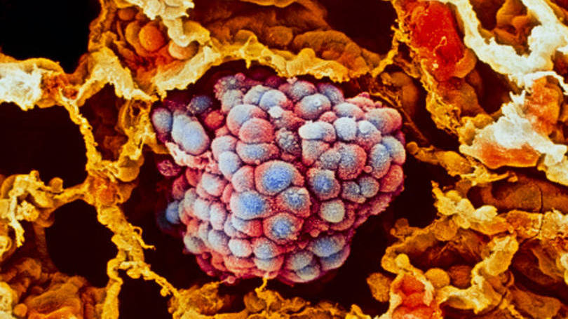 Câncer: a potencial vacina ataca tumores como se eles fossem vírus