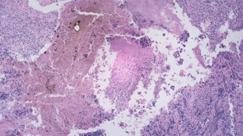 Câncer de pele: "Constitui, portanto um alvo terapêutico e diagnóstico bastante específico e promissor a ser explorado”